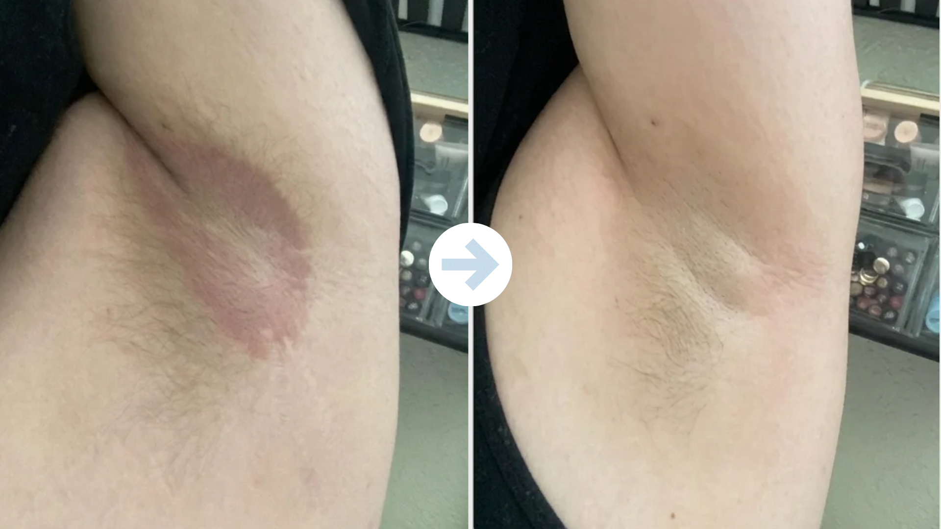 Armpit rash finally felt less angry