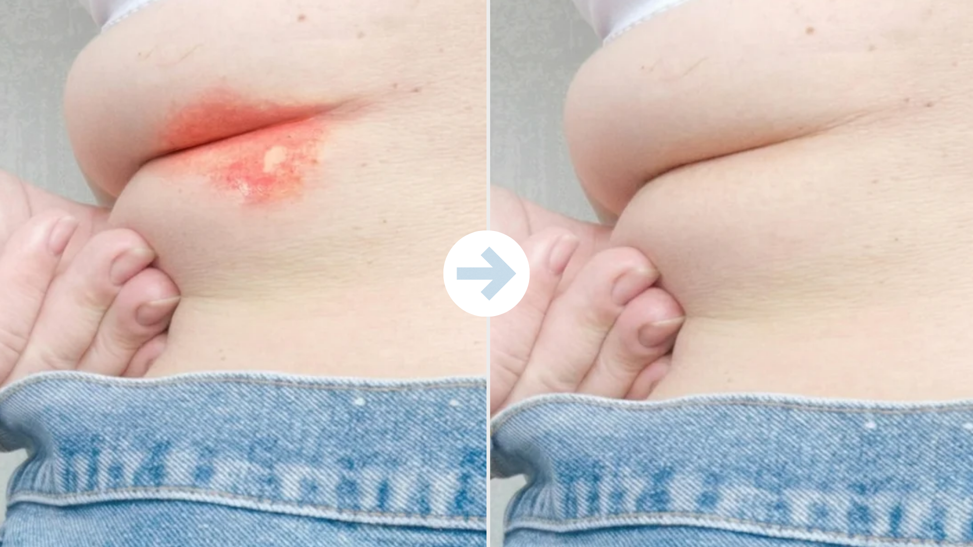 Belly rash felt easier to manage