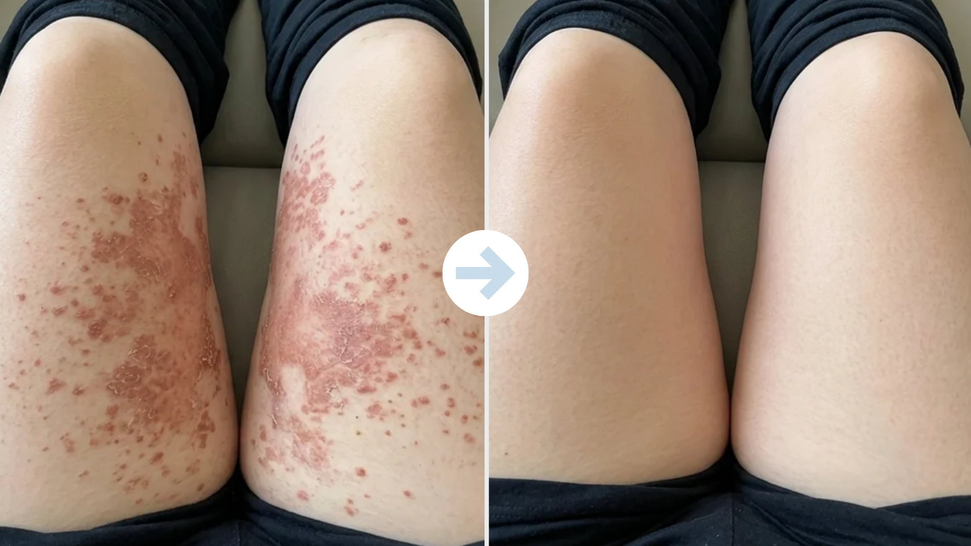 Thigh rash stopped stealing my walks