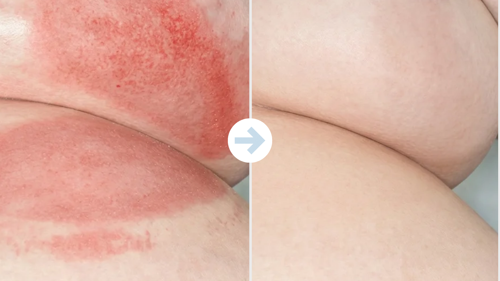 Underboob rash felt calmer fast